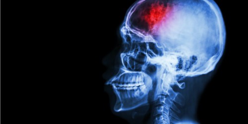 Periodontitis And Your Brain: Can Advanced Periodontal (Gum) Disease Cause A Stroke?
